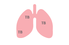 Human lungs with TB infection